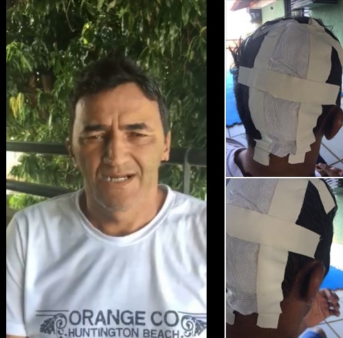 Tererê grava vídeo falando de cirurgia na cabeça que fez após ser atropelado em Teresina