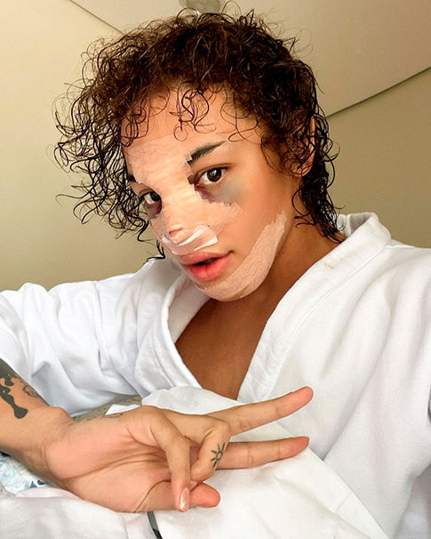 Pabllo Vittar aparece com curativos e hematomas após rinoplastia